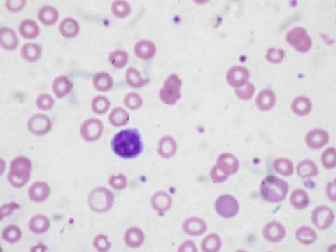Anemia: Conheça os Sintomas de Falta de Sangue e os Alimentos que…