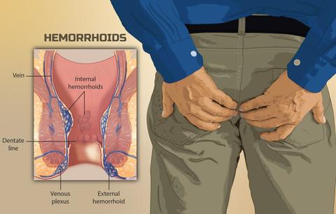 Hämorrhoiden (Wasir): Symptome erkennen und Behandlungsmöglichkeiten